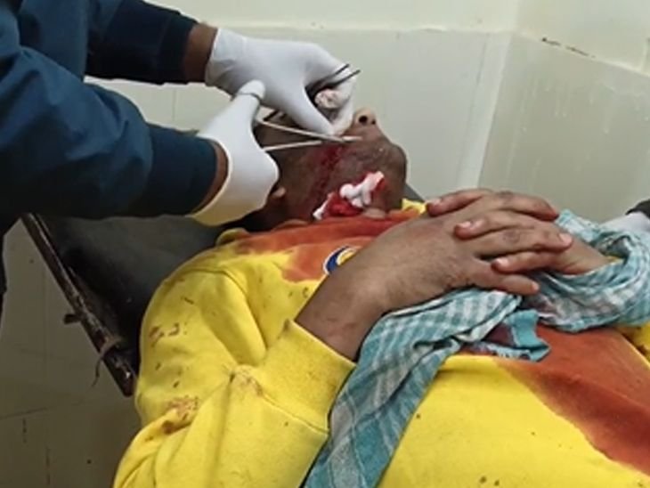 इंस्टाग्राम पर पोस्ट की लड़की की फोटो, विरोध करने पर मारा चाकू | असमंजस में लड़की का फोटो डाला, मारा चाकू पर विरोध: प्लॉट ने दो भाई और माता-पिता को घायल कर दिया, रिम्स रेम्स - चतरा समाचार